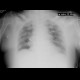 Lung congestion, supine: X-ray - Plain radiograph